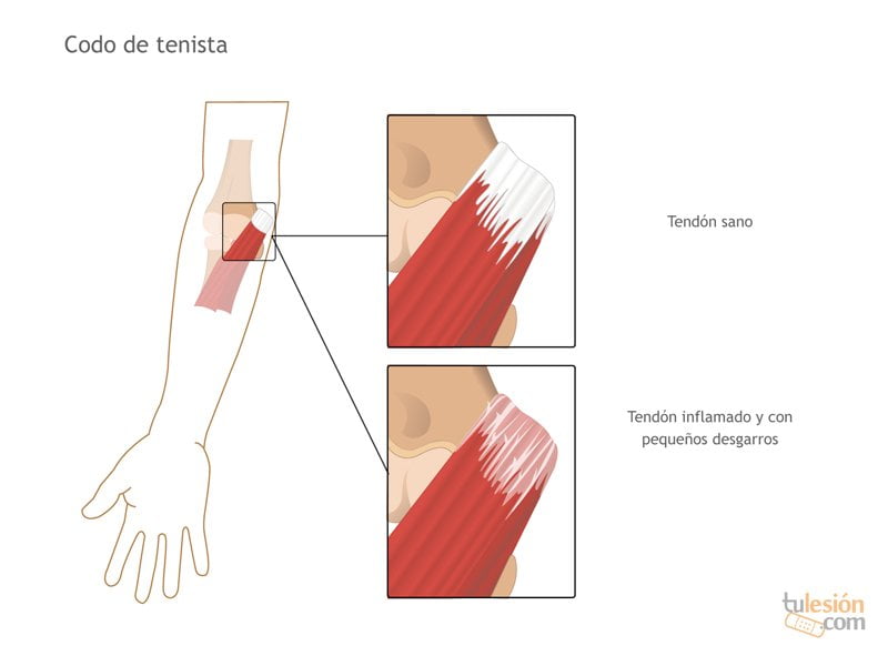 Lesiones más frecuentes en el #Tenis